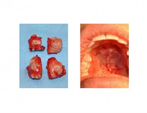 excision-of-palatal-torus-dr-barry-eppley-indianapolis1