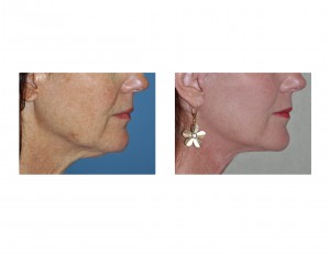 limited-facelift-result-dr-barry-eppley-indianapolis-side-view