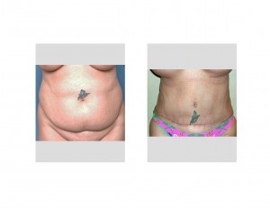 tummy-tuck-flap-movement-result-front-view