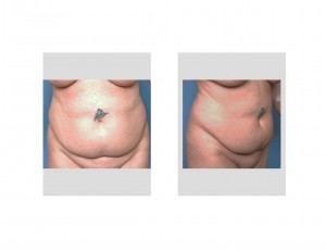 tummy-tuck-with-tattoo-before-surgery