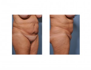 abdominal-fullness-with-pubic-sag-dr-barry-eppley-indianapolis