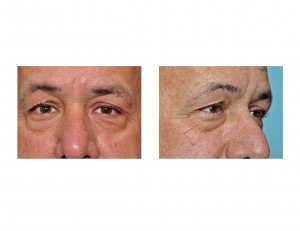 aging-eyes-in-men-dr-barry-eppley-indianapolis1
