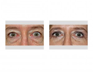 blepharoplasties-in-women-results-front-view-dr-barry-eppley-indianapolis