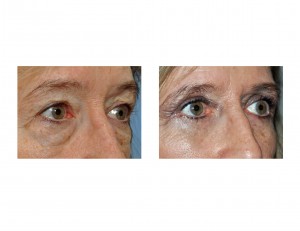 blepharoplasties-in-women-resuts-right-oblique-view-dr-barry-eppley-indianapolis