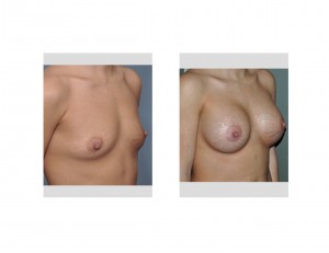 breast-augmentation-with-stretch-marks-right-oblique-view-dr-barry-eppley-indianapolis