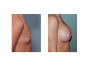 breast-augmentation-with-stretch-marks-side-view-dr-barry-eppley-indianapolis