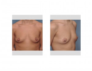 breasts-with-stretch-marks-dr-barry-eppley-indianapolis