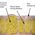 cellulite-anatomy-dr-barry-eppley-indianapolis