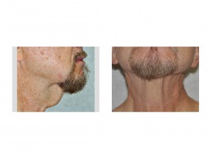 direct-necklift-before-surgery-dr-barry-eppley-indianapolis