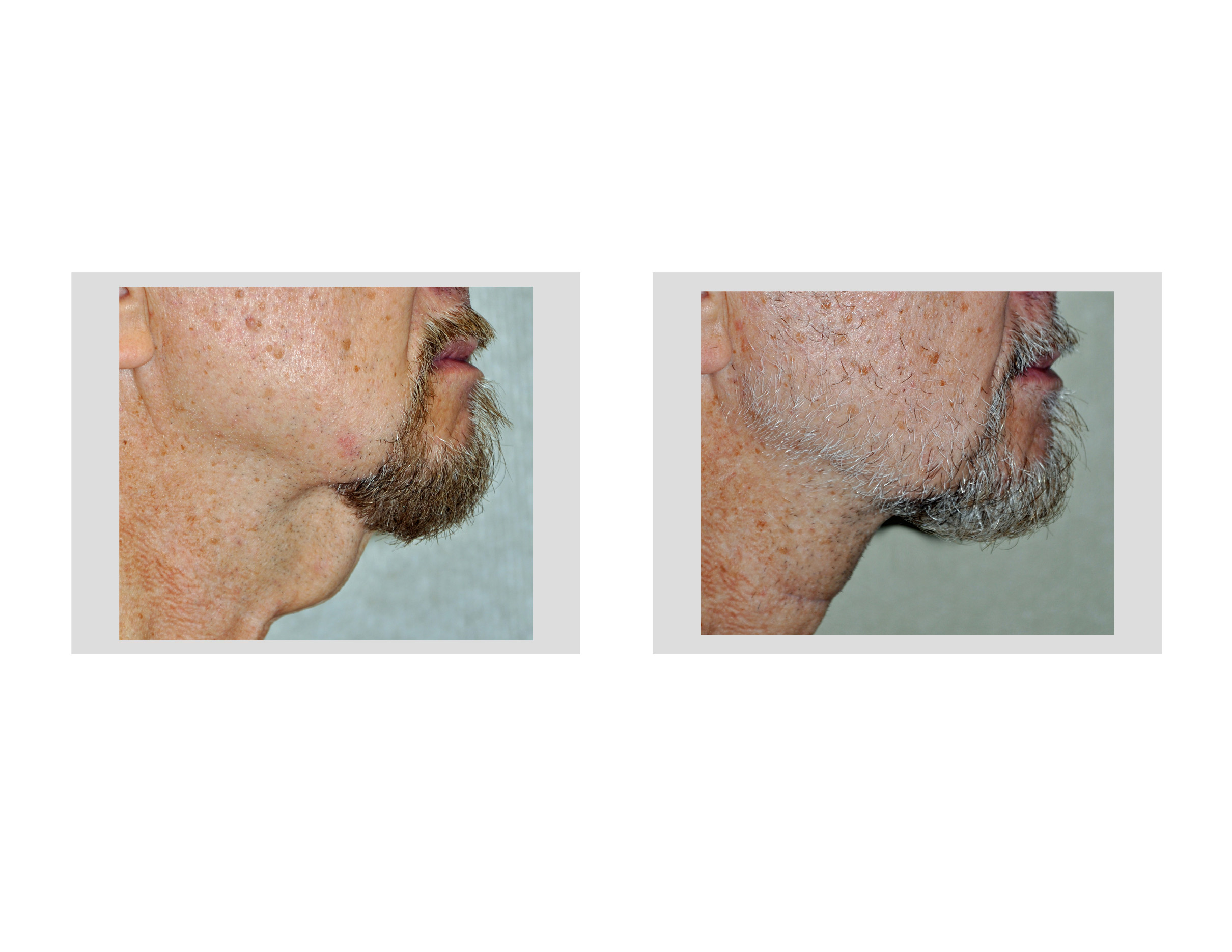 direct-necklift-result-side-view-dr-barry-eppley-indianapolis1