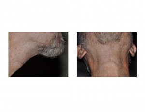 direct-necklift-scar-result-dr-barry-eppley-indianapolis