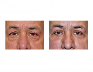 eyelid-surgery-in-men-results-front-view-dr-barry-eppley-indianapolis
