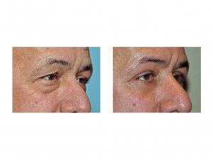 eyelid-surgery-in-men-results-right-oblique-view-dr-barry-eppley-indianapolis