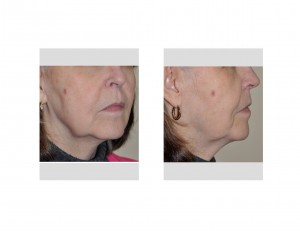 facial-aging-jowls-dr-barry-eppley-indianapolis