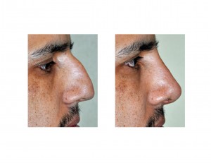 hump-reduction-rhinoplasty-dr-barry-eppley-indianapolis2