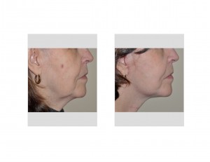 limited-facelift-quicklift-results-side-view-dr-barry-eppley-indianapolis