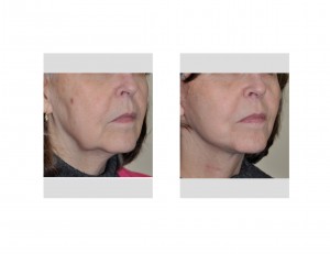 limitred-facelift-quicklift-results-right-oblique-view-dr-barry-eppley-indianapolis