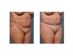 tummy-tuck-with-pubic-liposuction-results-oblique-view-dr-barry-eppley-indianapolis