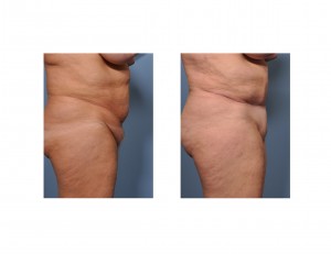 tummy-tuck-with-pubic-liposuction-results-side-view-dr-barry-eppley-indianapolis