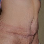 abdominal-shelf-deformity-right-oblique-view-dr-barry-eppley-indianapolis1