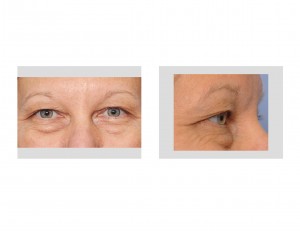 female-puffy-eyes-dr-barry-eppley-indianapolis