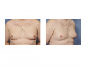 gynecomastia-indianapolis-dr-barry-eppley