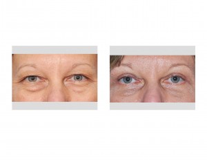 puffy-eye-blepharoplasty-results-dr-barry-eppley-indianapolis