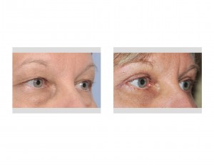 puffy-eye-blepharoplasty-results-right-oblique-view-dr-barry-eppley-indianapolis
