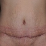 tummy-tuck-scar-dr-barry-eppley-indianapolis
