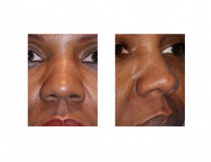 african-american-nose-dr-barry-eppley-indianapolis1
