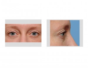 aging-eyes-in-younger-woman-dr-barry-eppley-indianapolis