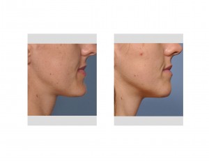 female-chin-reduction-result-dr-barry-eppley-indianapolis