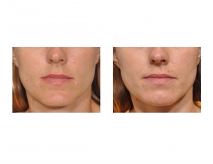 female-chin-reduction-result-front-view-dr-barry-eppley-indianapolis