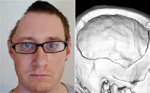 head-reshaped-with-fat-dr-barry-eppley-indianapolis-21