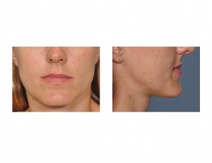 large-female-chin-dr-barry-eppley-indianapolis