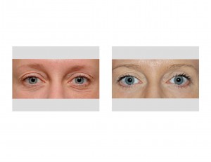 mini-blepharoplasty-pinch-blepharoplasty-result-frontal-view-dr-barry-eppley-indianapolis