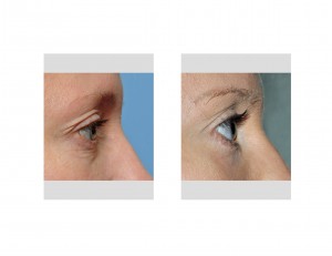 mini-blepharoplasty-pinch-blepharoplasty-results-side-view-dr-barry-eppley-indianapolis