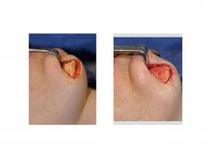 submental-chin-reduction-technique-dr-barry-eppley-indianapolis