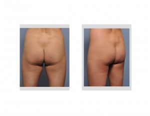 brazilian-butt-lift-in-thin-woman-before-dr-barry-eppley-indianapolis1