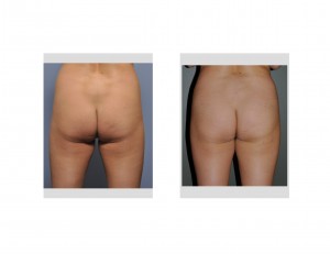 brazilian-butt-lift-in-thin-woman-result-back-view-dr-barry-eppley-indianapolis1