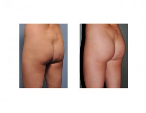 brazilian-butt-lift-in-thin-woman-result-left-oblique-view-dr-barry-eppley-indianapolis1