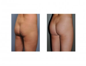 brazilian-butt-lift-in-thin-woman-result-right-oblique-view-dr-barry-eppley-indianapolis1