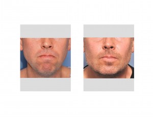 chin-and-jaw-angle-implants-result-front-view-dr-barry-eppley-indianapolis