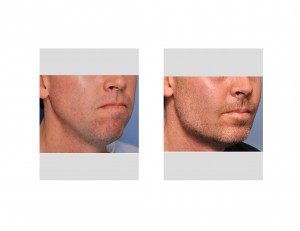 eppley-jaw-angle-augmentation-result-right-oblique-view