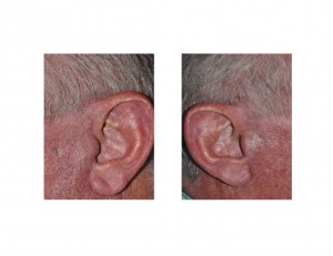 male-facelift-scars-dr-barry-eppley-indianapolis