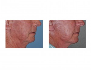 mini-facelift-older-male-result-side-view