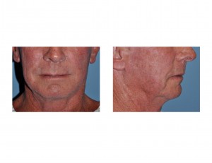 older-male-jowl-and-neck-sagging-dr-barry-eppley-indianapolis