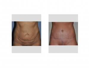 thin-woman-timmy-tuck-result-front-view-dr-barry-eppley-indianapolis