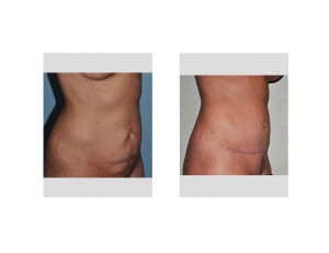 thin-woman-tummy-tuck-result-dr-barry-eppley-indianapolis