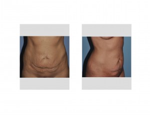 thin-women-tummy-tuck-dr-barry-eppley-indianapolis